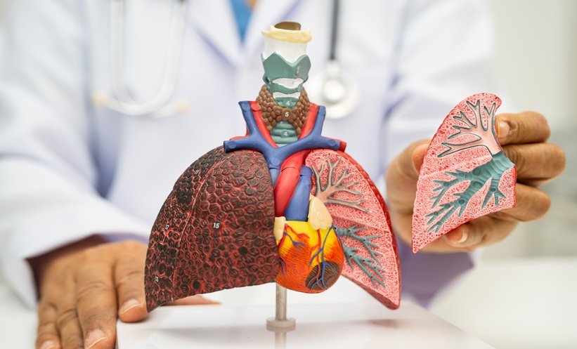 Lung Transplant in Stage IV NSCLC