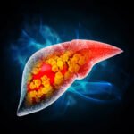 Key Drivers of Mortality in MASLD